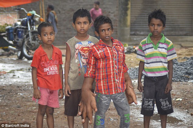 Индийский мальчик с гигантскими руками, размер которых больше его собственной головы Kaleem India hands, Калим Кэлим гигантские руки