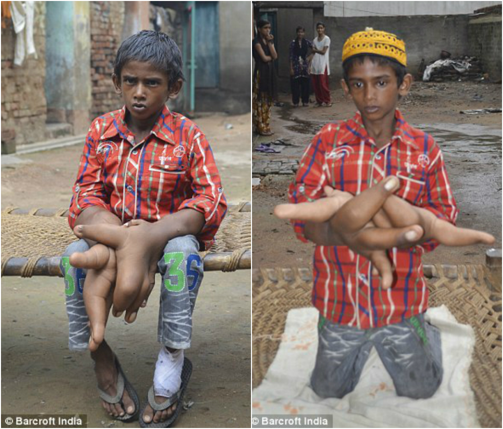 Индийский мальчик с гигантскими руками, размер которых больше его собственной головы Kaleem India hands, Калим Кэлим гигантские руки