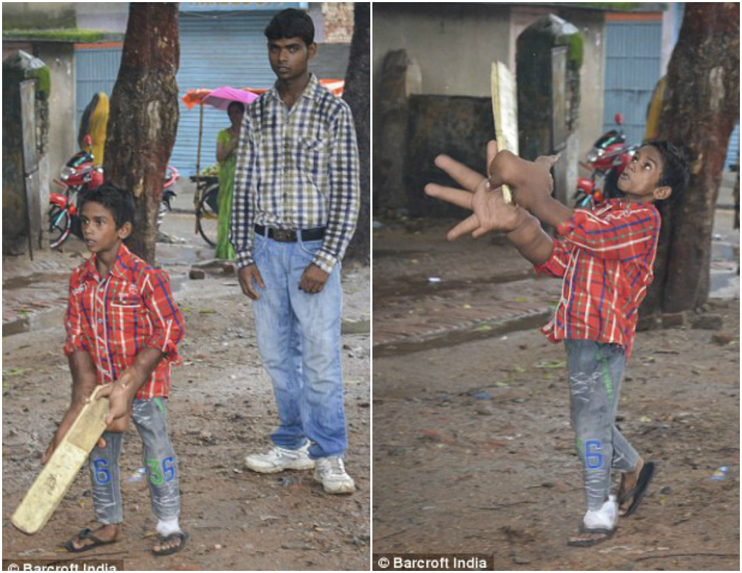 Индийский мальчик с гигантскими руками, размер которых больше его собственной головы Kaleem India hands, Калим Кэлим гигантские руки