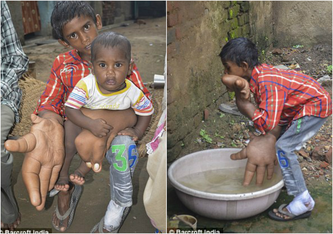 Индийский мальчик с гигантскими руками, размер которых больше его собственной головы Kaleem India hands, Калим Кэлим гигантские руки