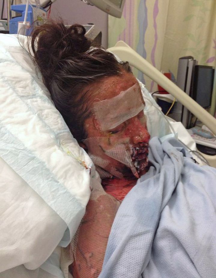 Leanne Howes Stevens-Johnson syndrome ранитидин