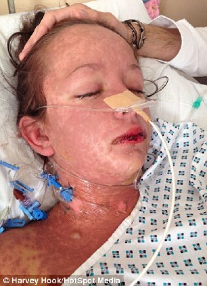 Leanne Howes Stevens-Johnson syndrome ранитидин