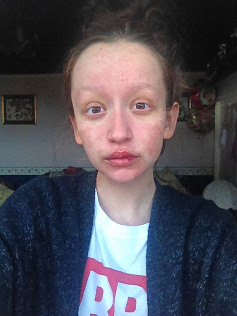 Leanne Howes Stevens-Johnson syndrome ранитидин