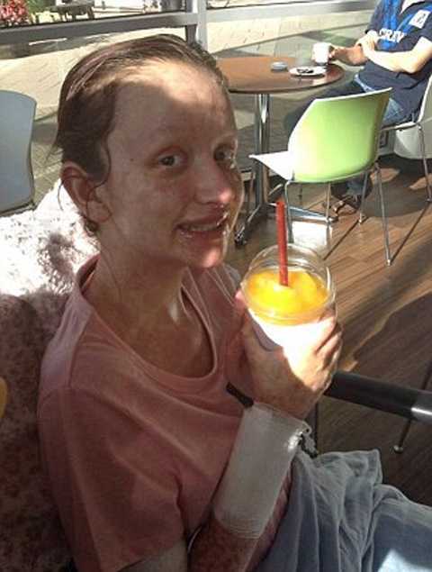 Leanne Howes Stevens-Johnson syndrome ранитидин