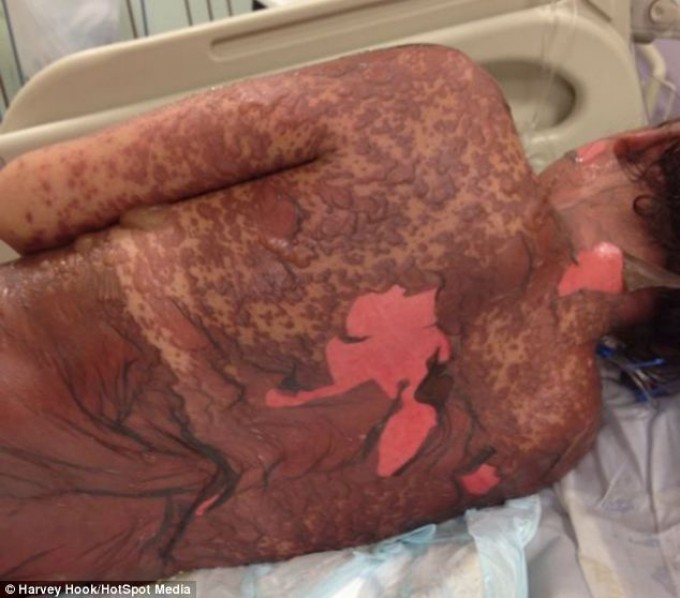 Leanne Howes Stevens-Johnson syndrome ранитидин