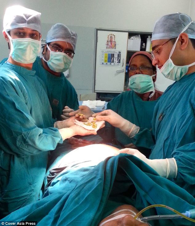 хирурги достали из живота 12 слитков золота, индийские хирурги достали слитки золота, 12 слитков золота в животе, перевез золото через границу