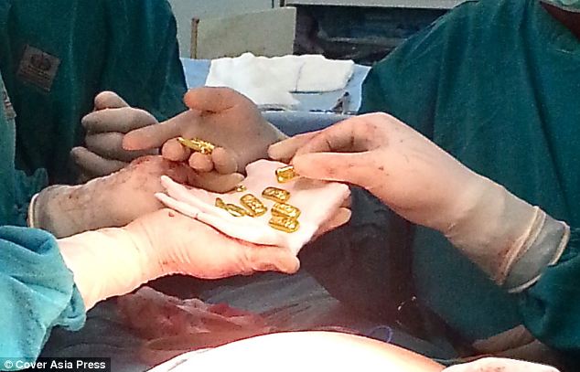 хирурги достали из живота 12 слитков золота, индийские хирурги достали слитки золота, 12 слитков золота в животе, перевез золото через границу