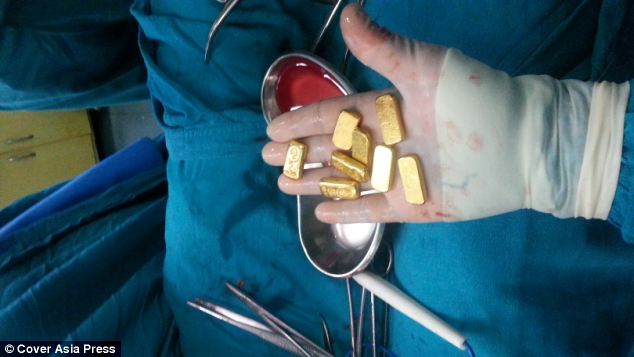 хирурги достали из живота 12 слитков золота, индийские хирурги достали слитки золота, 12 слитков золота в животе, перевез золото через границу