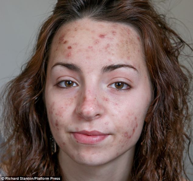 Самана Уэйк, Samantha Wake, расцарапывает себе лицо в кровь, обсессивно-компульсивное расстройство