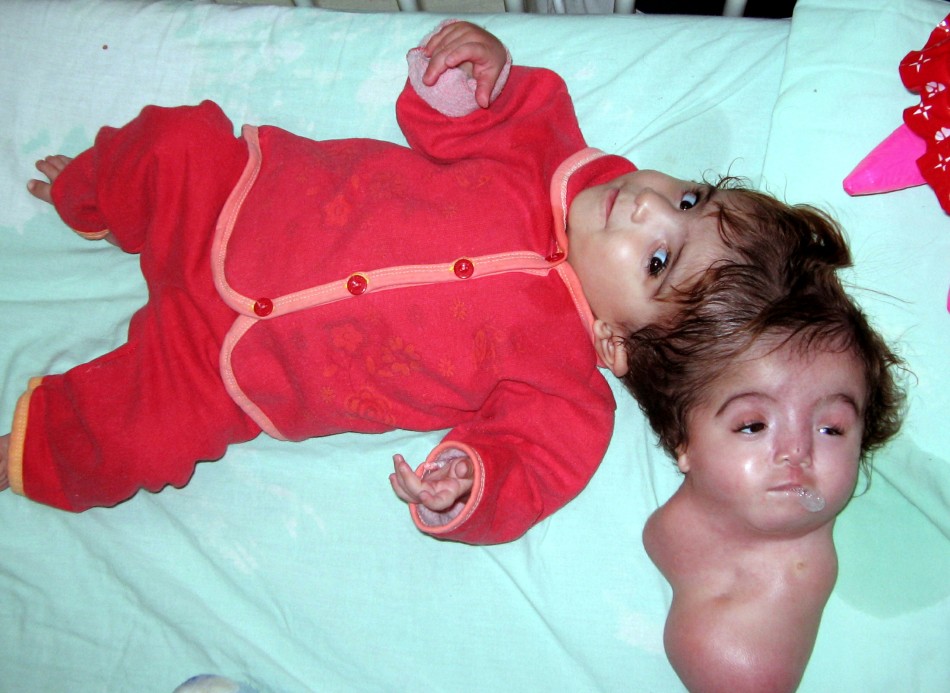 врожденные болезни детей, врожденные дефекты у детей, детские синдромы