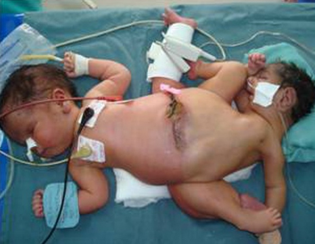 врожденные болезни детей, врожденные дефекты у детей, детские синдромы