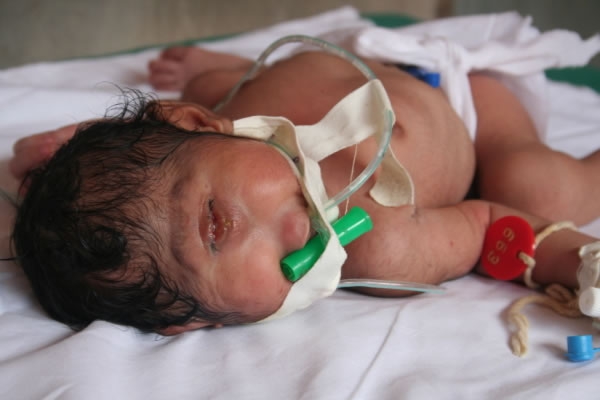 врожденные болезни детей, врожденные дефекты у детей, детские синдромы