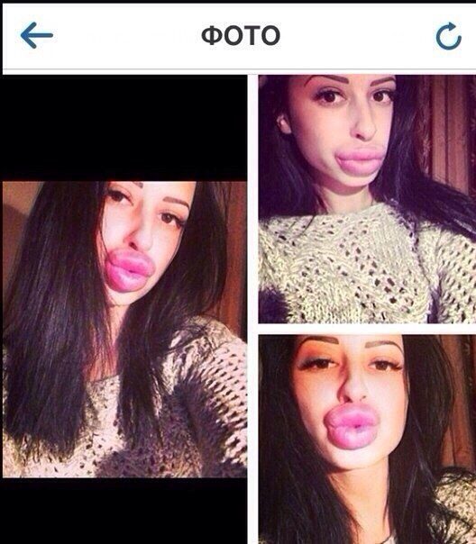 ботокс в губах, гламурные девушки, накаченные губы