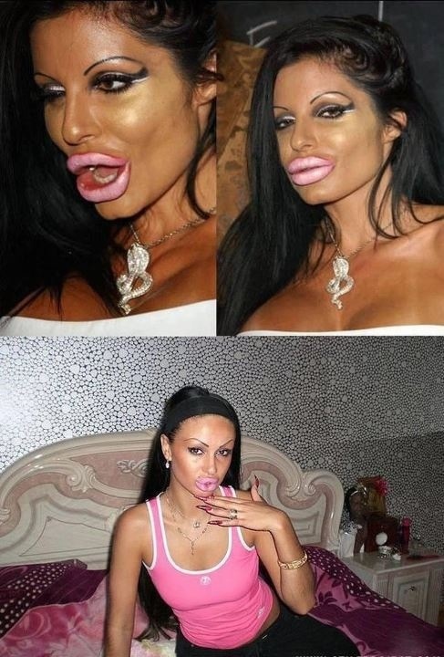 ботокс в губах, гламурные девушки, накаченные губы