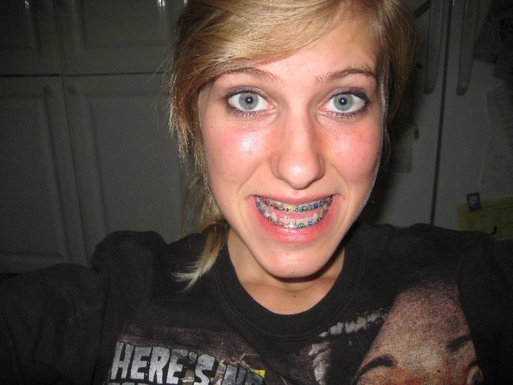 Невероятное преображение лица девушки после пластической операции по изменению нижней челюсти до и после челюстной хирургии, до и после пластической операции на челюсти, девушка после операции на челюсти