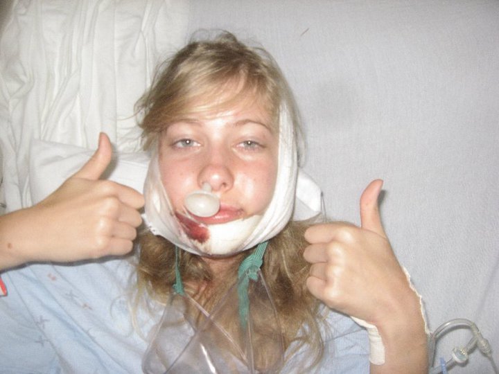 Невероятное преображение лица девушки после пластической операции по изменению нижней челюсти до и после челюстной хирургии, до и после пластической операции на челюсти, девушка после операции на челюсти