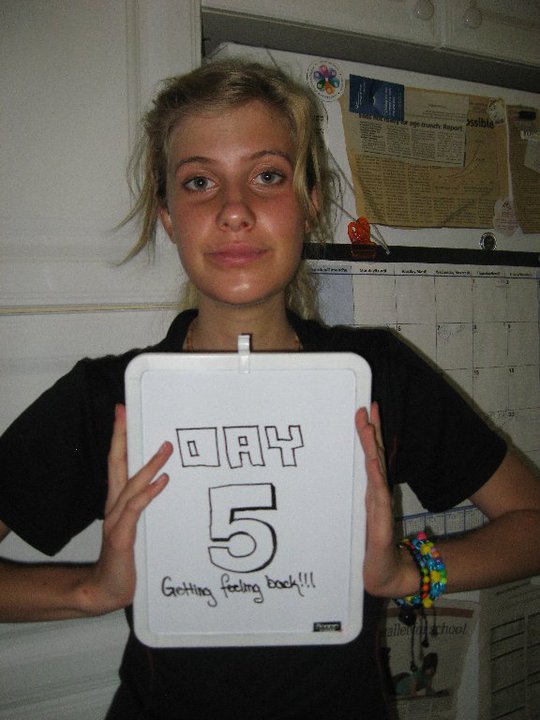 Невероятное преображение лица девушки после пластической операции по изменению нижней челюсти до и после челюстной хирургии, до и после пластической операции на челюсти, девушка после операции на челюсти