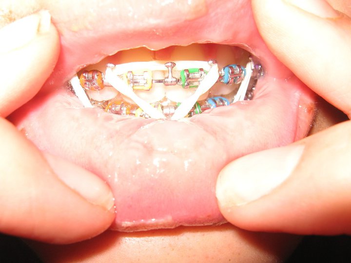 Невероятное преображение лица девушки после пластической операции по изменению нижней челюсти до и после челюстной хирургии, до и после пластической операции на челюсти, девушка после операции на челюсти