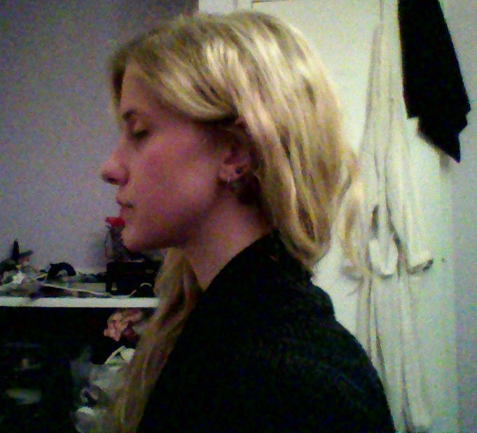 Невероятное преображение лица девушки после пластической операции по изменению нижней челюсти до и после челюстной хирургии, до и после пластической операции на челюсти, девушка после операции на челюсти