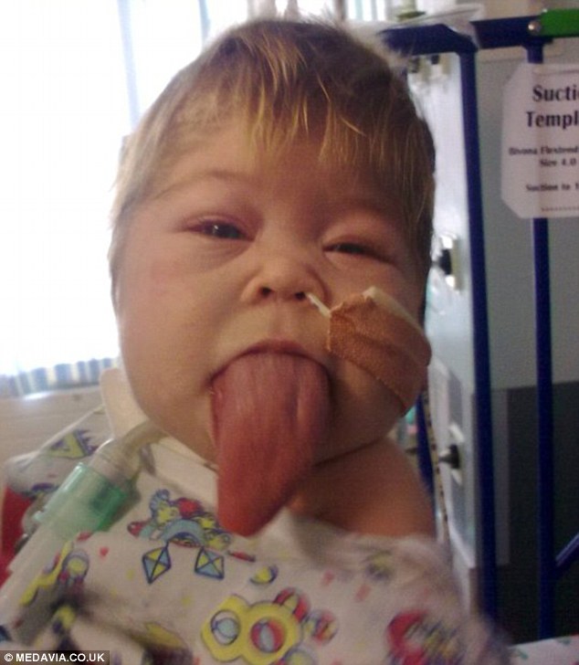 огромный язык, синдром Беквита-Видемана, Оливия Гиллис