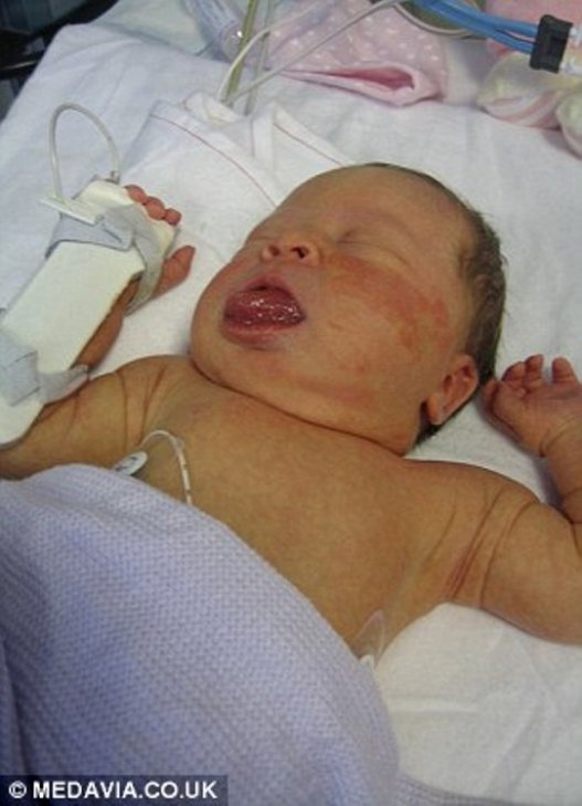 огромный язык, синдром Беквита-Видемана, Оливия Гиллис