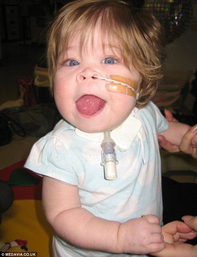 огромный язык, синдром Беквита-Видемана, Оливия Гиллис