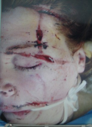 Фантастическое преображение женщины, которая потеряла ногу и ослепла на один глаз после взрыва Ханна Кемпбелл, Hannah Campbell, пластические операции после взрыва, восстановление после взрыва