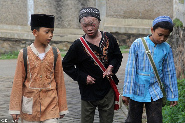 Мальчик-змея ежемесячно меняет кожу и постоянно принимает ванну, чтобы не высохнуть Snake Boy Ari Wibowo, мальчик-змея, Ари Вибово