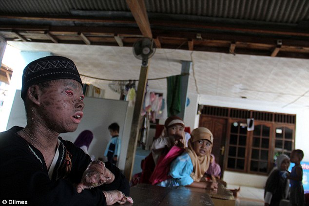 Мальчик-змея ежемесячно меняет кожу и постоянно принимает ванну, чтобы не высохнуть Snake Boy Ari Wibowo, мальчик-змея, Ари Вибово