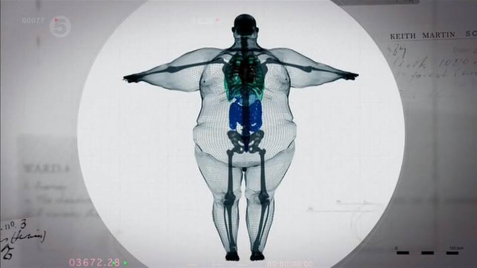 x ray fat person, рентген 400 кг, кейт мартин, x ray keith martin