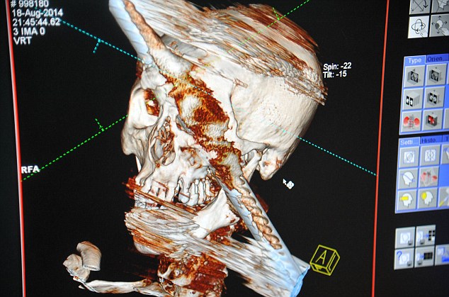 Металлический лом насквозь пробил голову китайца, но тот чудом остался жив лом пробил голову насквозь, металлический прут пробил голову насквозь, упал прут пробил голову насквозь