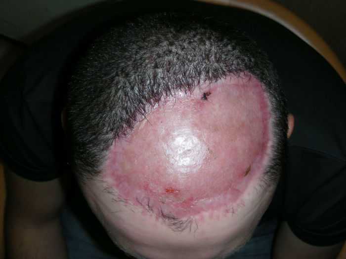 Chris Stoyanov Крис Стоянов, врачи избавили мужчины от лысины