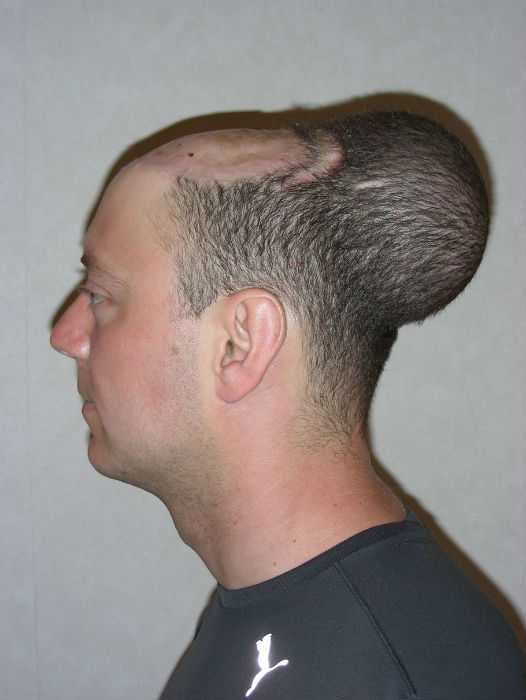 Chris Stoyanov Крис Стоянов, врачи избавили мужчины от лысины