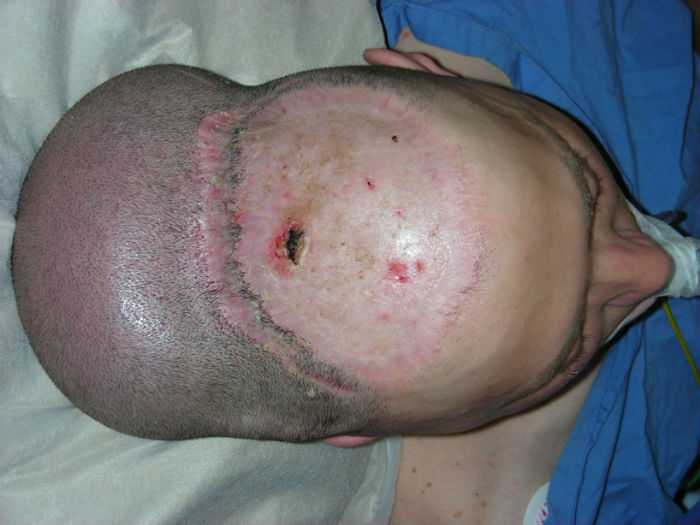 Chris Stoyanov Крис Стоянов, врачи избавили мужчины от лысины