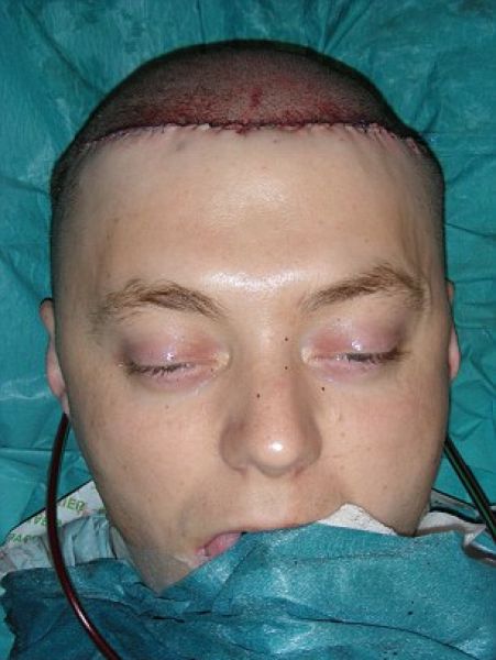 Chris Stoyanov Крис Стоянов, врачи избавили мужчины от лысины