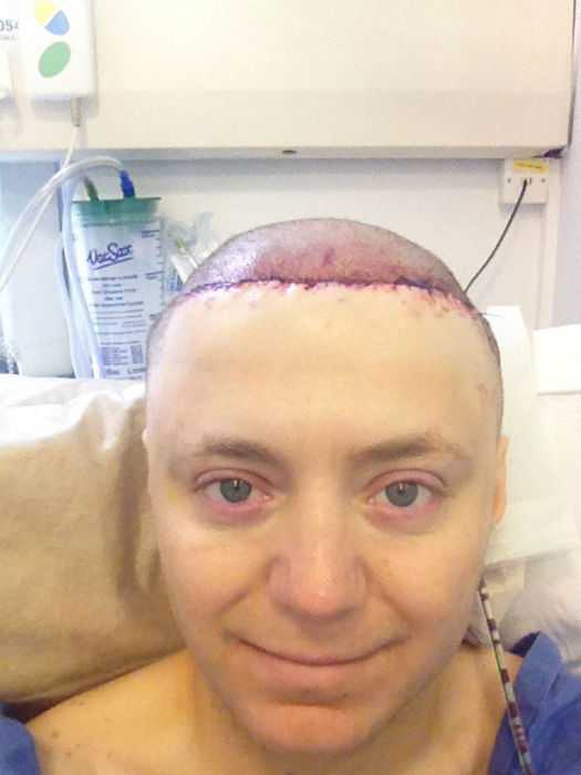 Chris Stoyanov Крис Стоянов, врачи избавили мужчины от лысины