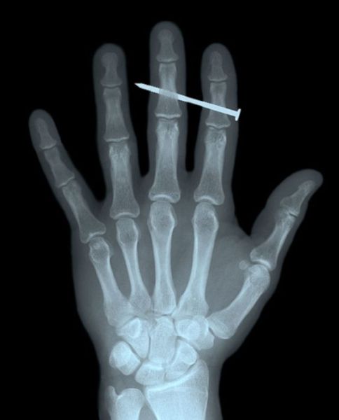 шокирующие рентгеновские снимки, необычные рентгеновские снимки, рентгеновские снимки жесть