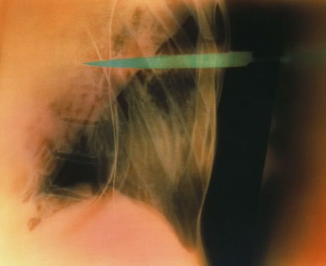 шокирующие рентгеновские снимки, необычные рентгеновские снимки, рентгеновские снимки жесть