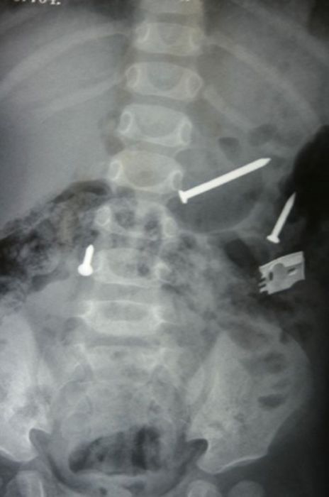 шокирующие рентгеновские снимки, необычные рентгеновские снимки, рентгеновские снимки жесть