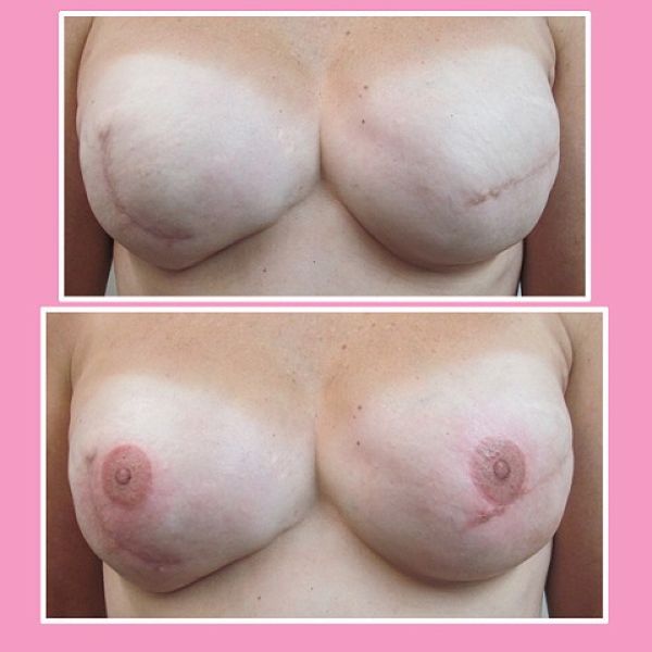 Винсент Майерс, Винни, Vincent Myers, Vinnie , татуировки сосков, рак молочной железы тату