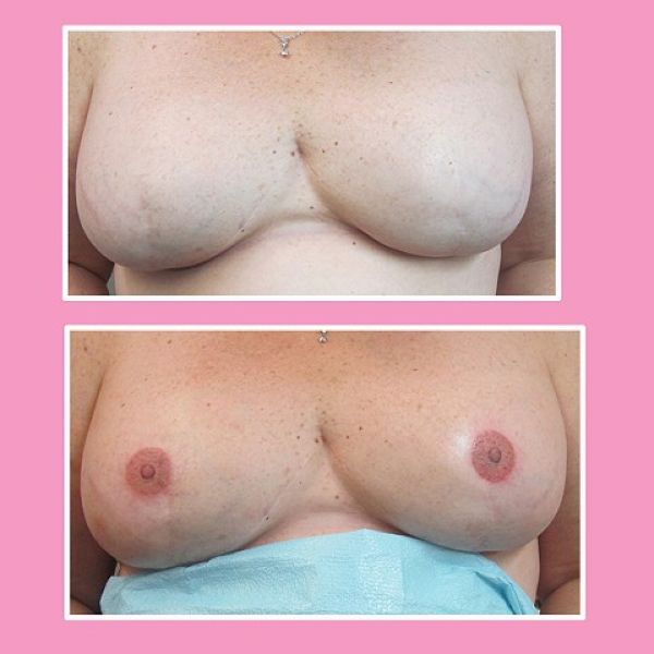 Винсент Майерс, Винни, Vincent Myers, Vinnie , татуировки сосков, рак молочной железы тату