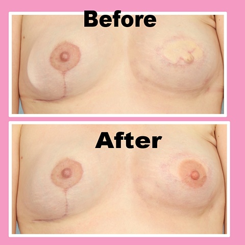 Винсент Майерс, Винни, Vincent Myers, Vinnie , татуировки сосков, рак молочной железы тату