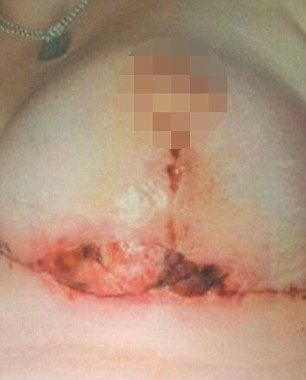 Грудь женщины буквально лопнула из-за установки слишком больших имплантов Неудачное увеличение груди, имплант прорвал кожу, имплант вылез наружу, Клэр Хокер, Claire Hawke