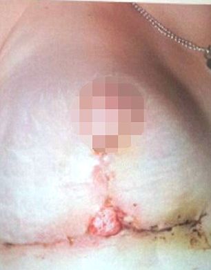 Грудь женщины буквально лопнула из-за установки слишком больших имплантов Неудачное увеличение груди, имплант прорвал кожу, имплант вылез наружу, Клэр Хокер, Claire Hawke