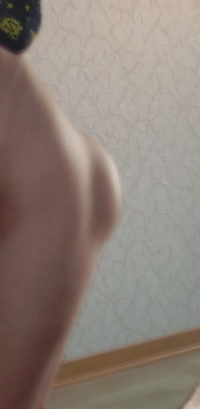 неудачная установка, ягодичные импланты, плохой опыт, неудачная пластическая операция