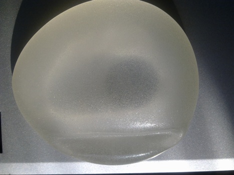 неудачная установка, ягодичные импланты, плохой опыт, неудачная пластическая операция