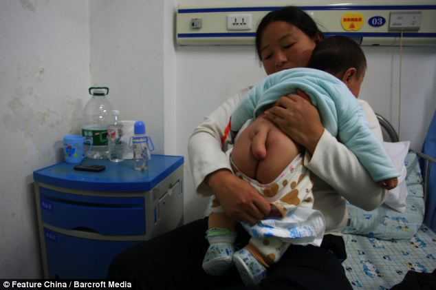 Обезумевшая от горя мать умоляет хирургов удалить её сыну хвост мать умоляет хирургов удалить её сыну хвост, мальчик с хвостом, человек с хвостом, расщелина позвоночника