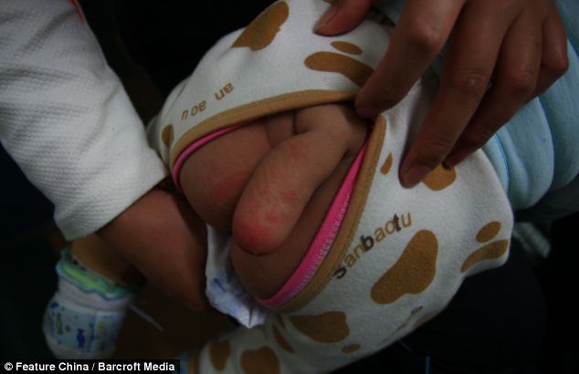 Обезумевшая от горя мать умоляет хирургов удалить её сыну хвост мать умоляет хирургов удалить её сыну хвост, мальчик с хвостом, человек с хвостом, расщелина позвоночника