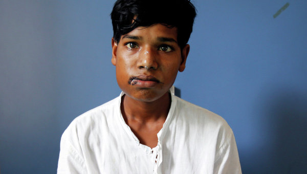 Хирурги удалили 232 зуба из рта, 232 зуба во рту индийского подростка, Ашик Гаваи, Ashik Gawai