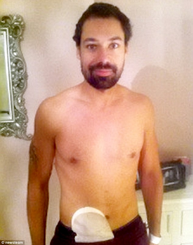 болезнь кишечника стал фитнес моделью, Блейк Бекфорд, Blake Beckford, колостомный мешок фитес модель, язвенный колит стал моделью